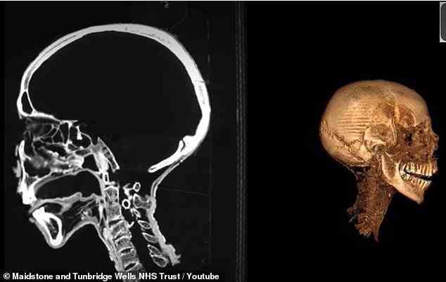 Die Bilder zeigen auch, dass ihr Gehirn entfernt wurde und ihre Zunge noch gut erhalten ist
