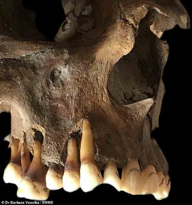 In der Studie extrahierte das Team virale DNA aus den Zähnen von vier Personen.  Eine Probe (im Bild) stammte von einem jungen erwachsenen Mann aus Holland und stammt aus dem Jahr 1672