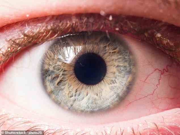 Glaukom, das durch eine Flüssigkeitsansammlung im Auge verursacht wird, kann zu irreversiblem Sehverlust führen.  Oben wird ein Archivbild verwendet