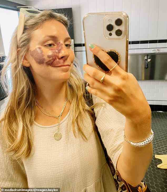 Reagan Baylee Campbell, 25, from Los Angeles, was born with a vascular birthmark on her face known as a port wine stain, which has no cure or treatment other than lightening surgery
