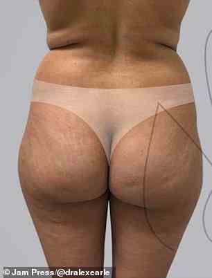 Dr. Earle recommends exercising to help get the ideal butt, however, he added that it's impossible to achieve without surgery. A patient is seen before surgery
