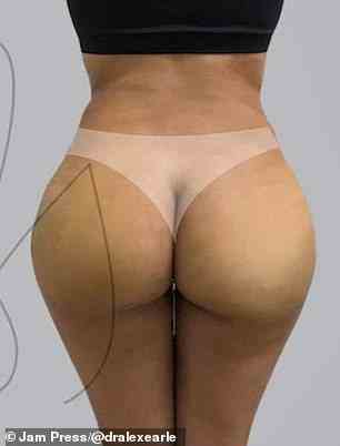 Dr. Earle recommends exercising to help get the ideal butt, however, he added that it's impossible to achieve without surgery. A patient is seen after surgery