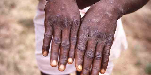 Dieses Bild, das 1997 von der CDC während einer Untersuchung eines Ausbruchs von Affenpocken in der Demokratischen Republik Kongo zur Verfügung gestellt wurde, zeigt die Hände eines Affenpockenpatienten.