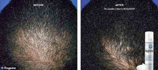 Regaine ist seit langem ein Favorit für Männer, um verlorenes Haar im Alter nachwachsen zu lassen, aber die Art und Weise, wie das Medikament verabreicht wurde, war möglicherweise nicht die effektivste
