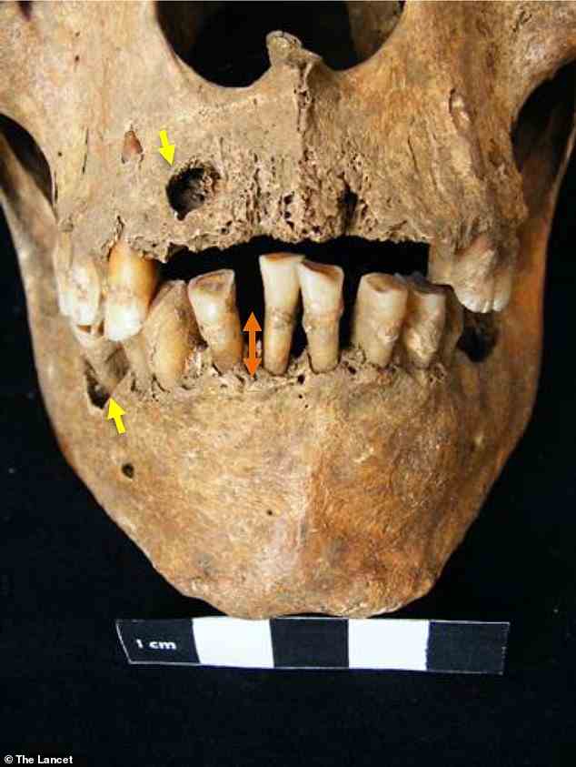 Obwohl die Archäologen nicht wussten, dass die Überreste von der Krankheit durchsetzt waren, weist der Schädel Anzeichen wie überdurchschnittlich große Zähne und eine schwere Zahnfleischentzündung auf, die das Weichgewebe in seinem Mund vor dem Tod beschädigte