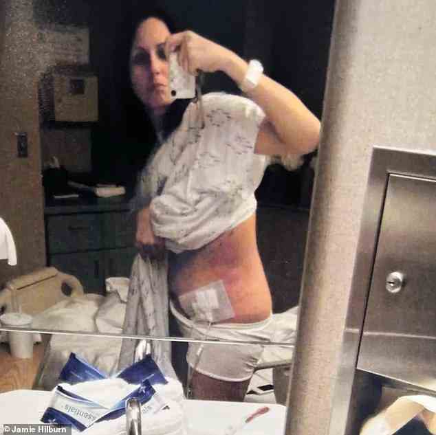 Jamie Hilburn, jetzt 39 und aus Edmond, Oklahoma, verbrachte zehn Tage im Krankenhaus, nachdem er sich nach einer Fettabsaugung und einer Bauchdeckenstraffung mit MRSA infiziert hatte.  Sie ist oben während der Behandlung der Infektion abgebildet