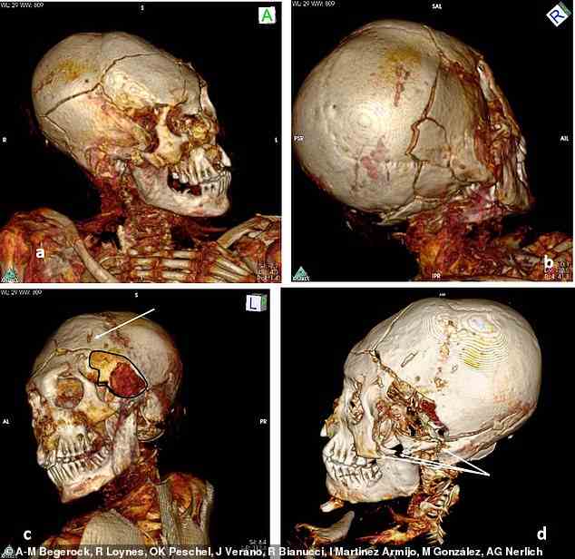 3D-CT-Scan des Schädels der männlichen Mumie von Délémont.  AC: Merkmale eines perimortalen Schädeltraumas auf der linken Seite des Schädels mit einer großen perforierenden Läsion im linken Schläfenbereich (angezeigt) und einer in den Schädel verlaufenden Fraktur.  D: Zygomfraktur auf der linken Seite (indiziert)