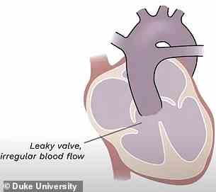 Owens Herz, das Truncus Arteriosus hatte, oder wo die Aorta und die Pulmonalarterie verschmolzen sind