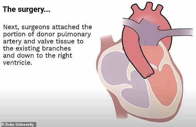 Sie verwendeten dann lebendes Gewebe, um den fehlenden Bereich der Aorta und den fehlenden Bereich der Lungenarterie zu ersetzen.  Es wurden auch neue Klappen aus dem Spenderherz hinzugefügt, um den Blutfluss zu kontrollieren