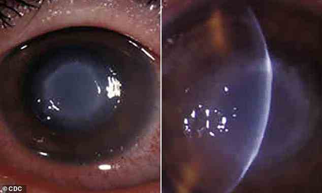 Oben abgebildet ist das trüb aussehende Auge, das durch eine Acanthamoeba-Keratitis (AK)-Infektion ausgelöst werden kann.  Ungefähr 85 Prozent der Fälle betreffen Kontaktlinsenträger (Archivbild)