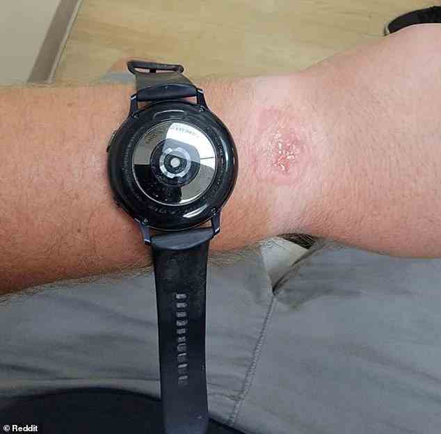 Ein Benutzer auf Reddit hat Bilder einer Verbrennung geteilt, von der er behauptet, dass sie von einer Samsung Galaxy Watch 2 verursacht wurde (oben).