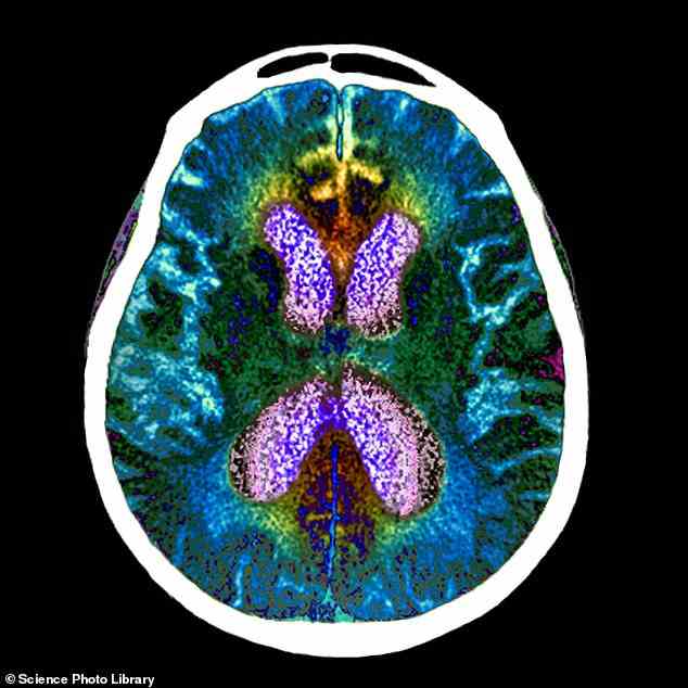 Ein experimentelles Alzheimer-Medikament namens Lecanemab hat in einer großen Patientenstudie den kognitiven und funktionellen Rückgang um 27 Prozent deutlich verlangsamt