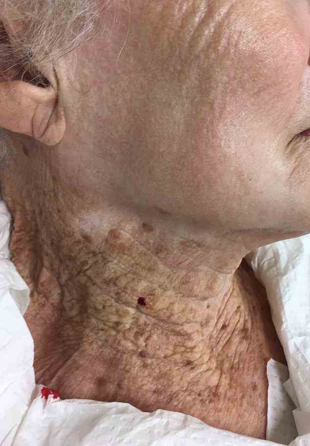 Eine 92-jährige Frau hat einen sonnengeschädigten Hals, der mit Falten und Altersflecken übersät ist, weil sie mehr als 40 Jahre lang keinen UV-Schutz unter ihrem Gesicht verwendet hat