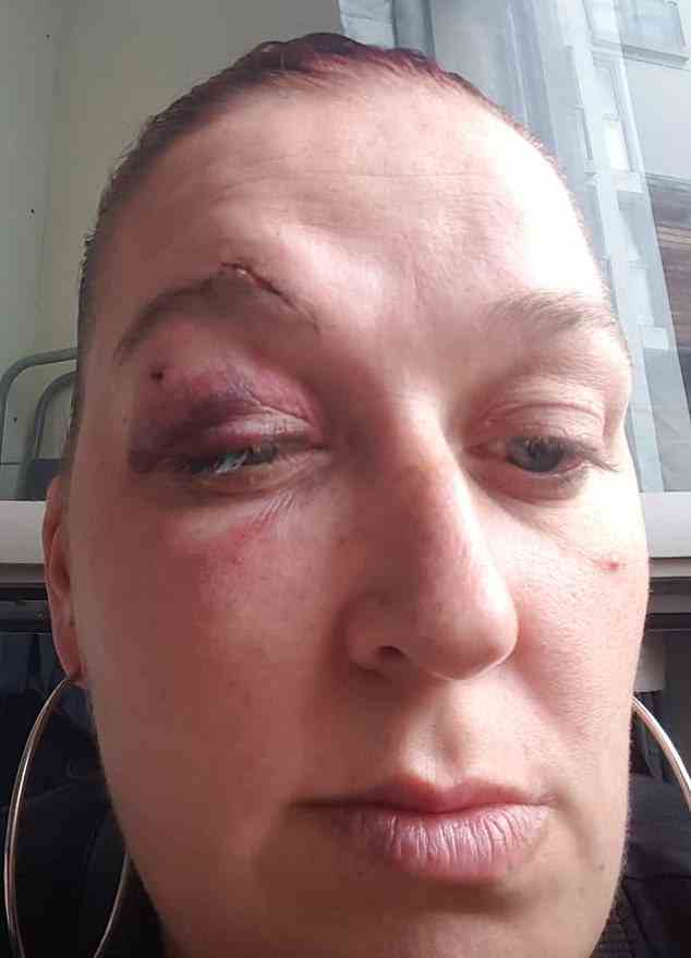 Shar hatte nach dem Angriff, als die Wunde im Gesicht verheilt war, immer noch Blutergüsse und musste über ihrem Auge genäht werden