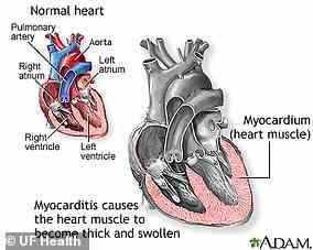Myokarditis ist eine seltene Erkrankung.  Meistens wird es durch eine Infektion verursacht, die das Herz erreicht