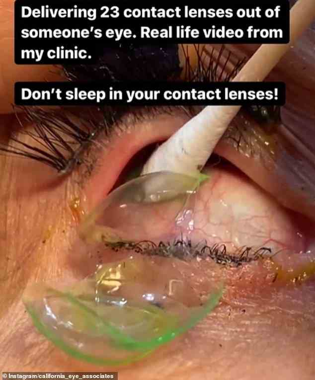 Optometristen auf der ganzen Welt verwenden das anschauliche Video, um ihre Patienten darüber aufzuklären, wie wichtig es ist, Kontaktlinsen jeden Tag vor dem Schlafengehen zu entfernen