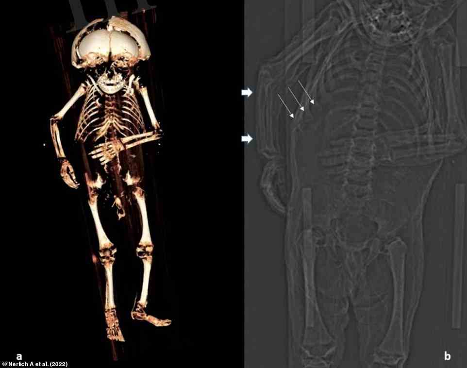Sein Körper wurde einem CT-Scan (Bild) unterzogen, der verräterische Anzeichen einer Lungenentzündung und eines Vitamin-D-Mangels zeigte.  A: Dreidimensionale Rekonstruktion des Skeletts.  B: Ein Abschnitt des Topogramms, der den Rosenkranz der costochondralen Verbindung in den Rippen (dünne Pfeile) zeigt, der auf Rachitis hindeutet