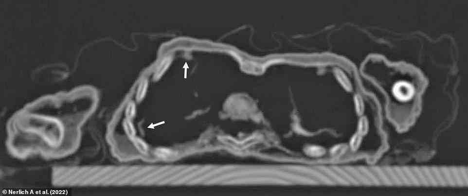 Axiale CT-Schnitte durch die Brust, die Reste von Lungengewebe in der rechten Brusthöhle mit einigen Adhäsionen zeigen, die auf eine Lungenentzündung hindeuten