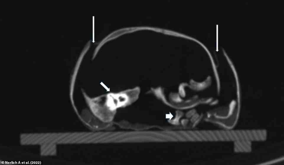 CT-Scan der Schädelbasis, der die ausgedehnte Dislokation der Knochen zeigt.  Es wird angenommen, dass der Schaden nach seinem Tod aufrechterhalten wurde, da es keine begleitenden Knochenbrüche, Blutrückstände oder Gewebeschäden gab.  Dünne Pfeile: Unterbrechung der Nähte.  Mittlerer Pfeil: Disloziertes rechtes Felsenbein.  Dicker Pfeil: Teile der Wirbelsäule ausgerenkt