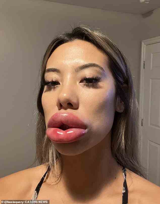 Basia Query, 24, aus Las Vegas, Nevada, sah, wie ihre Lippen auf das Dreifache ihrer normalen Größe anschwollen, was sie befürchtete, dass sie abgeschnitten würden, nachdem sie eine allergische Reaktion auf Füllstoffe hatte