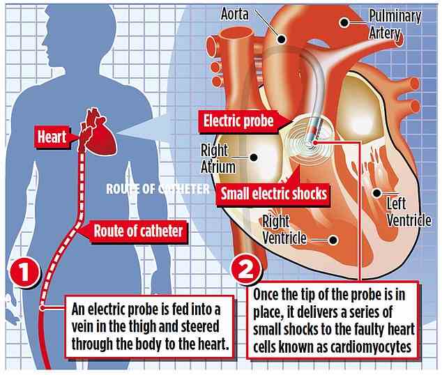 Dabei wird eine elektrische Sonde in eine Vene im Oberschenkel eingeführt und dann durch den Körper gelenkt, bis sie das Herz erreicht