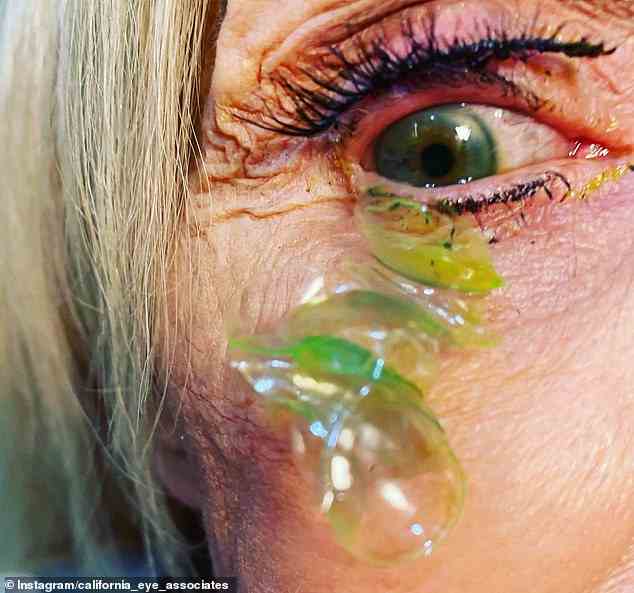 Insgesamt 23 Tageslinsen wurden im Auge einer Amerikanerin eingeschlossen