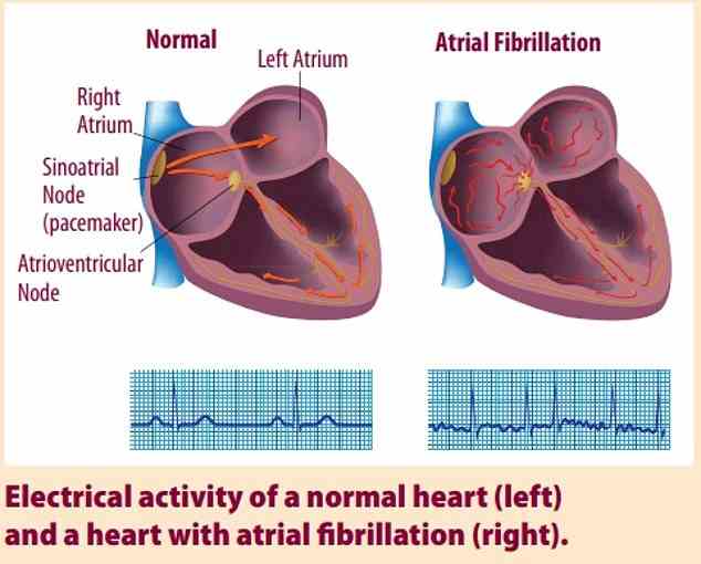 Vorhofflimmern ist eine häufige Form von Herzrhythmusstörungen.  Es tritt auf, wenn die oberen Kammern (Vorhöfe) des Herzens nicht synchron mit den unteren Kammern (Ventrikeln) schlagen.  Es kann zu unzähligen Herzerkrankungen sowie zu Blutgerinnseln führen, die das Schlaganfallrisiko erhöhen.