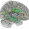Das zeigt ein Gehirnscan aus der Studie