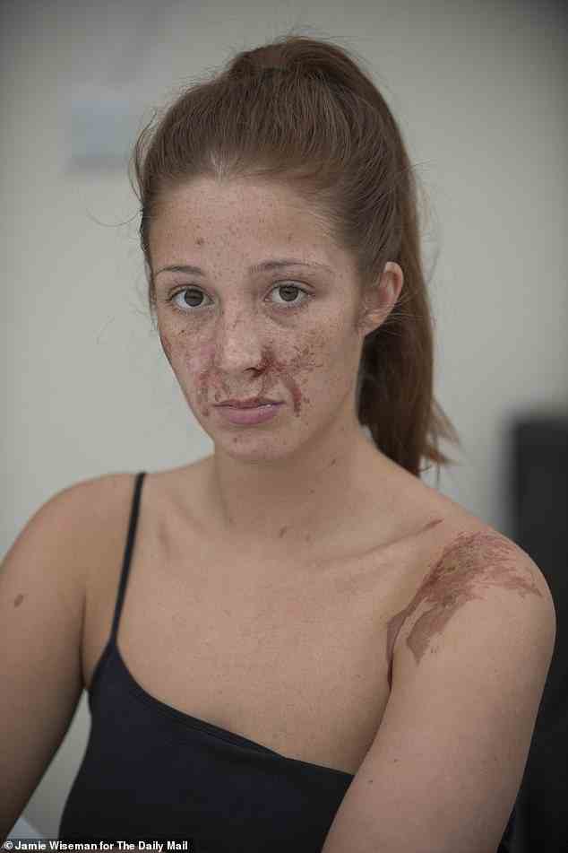 Bogen: Es wurde behauptet, sie bezögen sich auf Sophie Hall, die 15 Monate nach dem widerlichen Angriff das Finale einer Miss England erreichte und ihre Narben entblößte