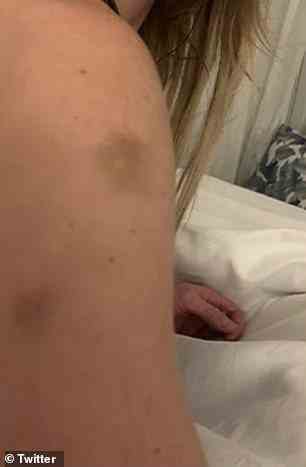 The photos show various parts of her body, like her ribs and arms, covered in bruises