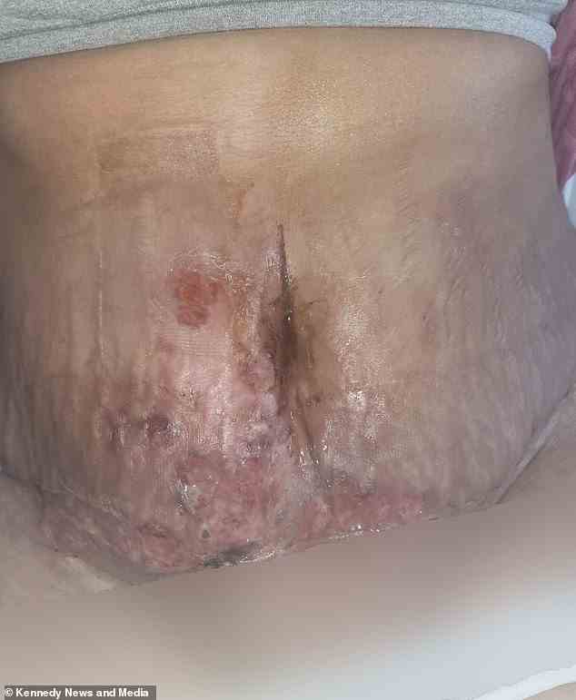 Der Kundenbetreuer benötigt möglicherweise eine Hauttransplantation, um die nekrotische Haut auf ihrem Bauch zu ersetzen