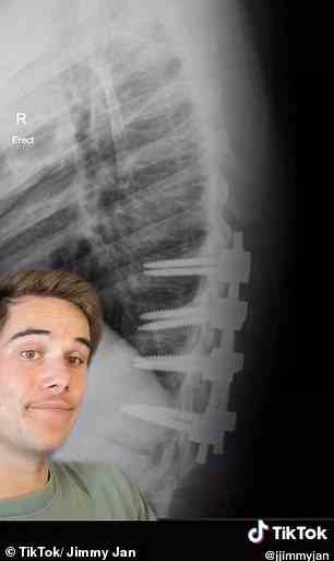 Doctors told Jimmy during the surgery they decompressed his spinal cord and stabilised the fractures with screws and rods