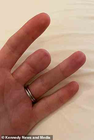 Frau Misselbrooks Finger nach der Amputation