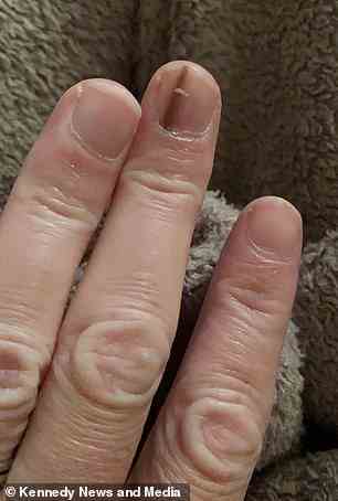 Elizabeth Misselbrook, 40, aus Bracknell, Berkshire, musste sich von Ärzten den Finger abhacken lassen, nachdem sie entdeckt hatten, dass eine braune Linie auf ihrem Nagel eine seltene Form von Hautkrebs war