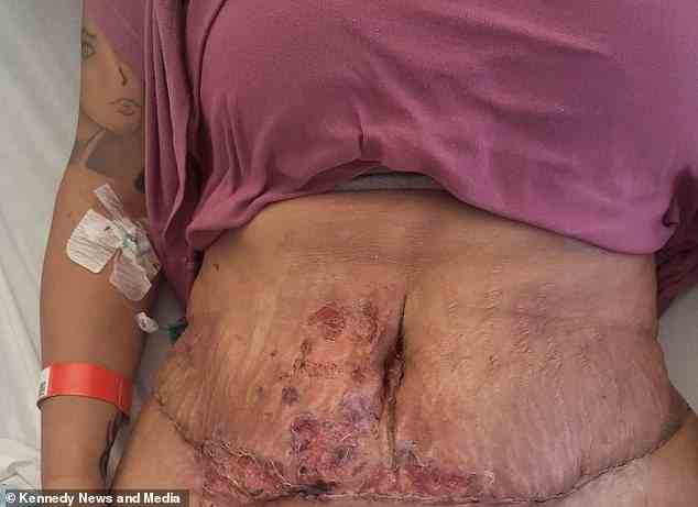 Der Bauch einer Mutter war mit verrottendem Fleisch bedeckt, nachdem sich eine verpfuschte Bauchdeckenstraffung in der Türkei infiziert und sie ins Krankenhaus gebracht hatte
