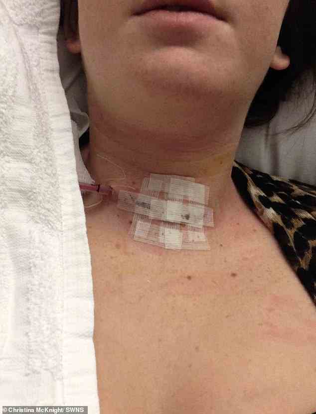Der Arzt erkannte schnell die Schilddrüsenkrebs-Symptome und bemerkte beim Abtasten um Christinas Hals eine Beule - von der sie nicht wusste, dass sie sie hatte.  Ein Ultraschall und eine Biopsie bestätigten, dass Christina Krebs hatte, dann wurde sie im November 2014 einer Thyreoidektomie unterzogen, um ihre Schilddrüse entfernen zu lassen (Bild nach der Operation).