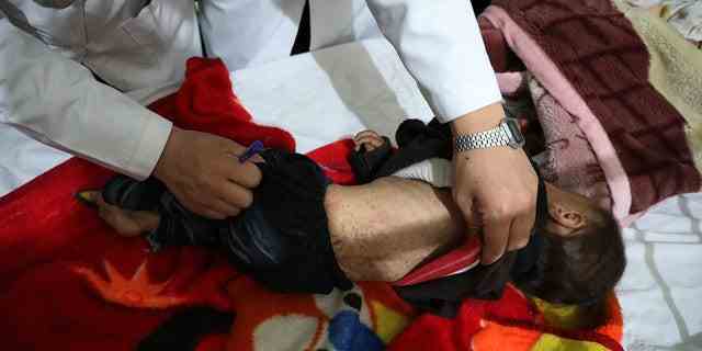 Ein an Masern erkranktes Kind in Afghanistan während eines tödlichen Ausbruchs im Land in diesem Jahr. 