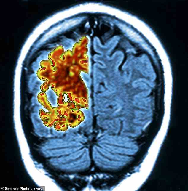 Bluttests zum Nachweis von Alzheimer haben in der Vergangenheit das Ziel bei der Messung der Neurodegeneration verfehlt, aber Wissenschaftler haben einen neuen Weg gefunden, dies zu tun, indem sie ein Protein namens Tau aus dem Gehirn identifiziert haben