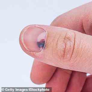Gequetschte Nägel werden normalerweise durch Verletzungen verursacht, z. B. wenn Sie Ihren Nagel in einer Tür einschließen.  Aber in sehr seltenen Fällen verschwindet der Bluterguss nicht mit der Zeit, was darauf hindeutet, dass es sich um Krebs handeln könnte