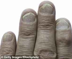 Lochfraß, Splittern oder Anheben der Nägel könnten ein Frühwarnzeichen für Arthritis sein, sagen Dermatologen.  Psoriasis betrifft normalerweise die Haut, kann aber in einigen Fällen nur die Nägel betreffen