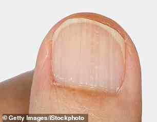 Rillen auf den Nägeln könnten ein normales Zeichen des Alterns sein, sagen Ärzte.  Sie können aber auch ein Zeichen für Reizungen durch übereifriges Waschen sein