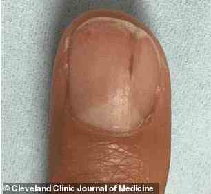 Unter den Nägeln können auch rote oder bräunliche Linien auftreten, die laut Dermatologen Warnzeichen für eine Herzinfektion sein können