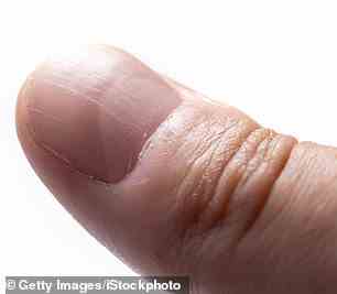 Eingeknüppelte Nägel könnten ein Warnzeichen für ein Lungenproblem sein