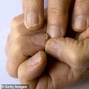 Brüchige Nägel, die leicht brechen, absplittern oder splittern, können ein Warnzeichen für eine schlechte Ernährung sein