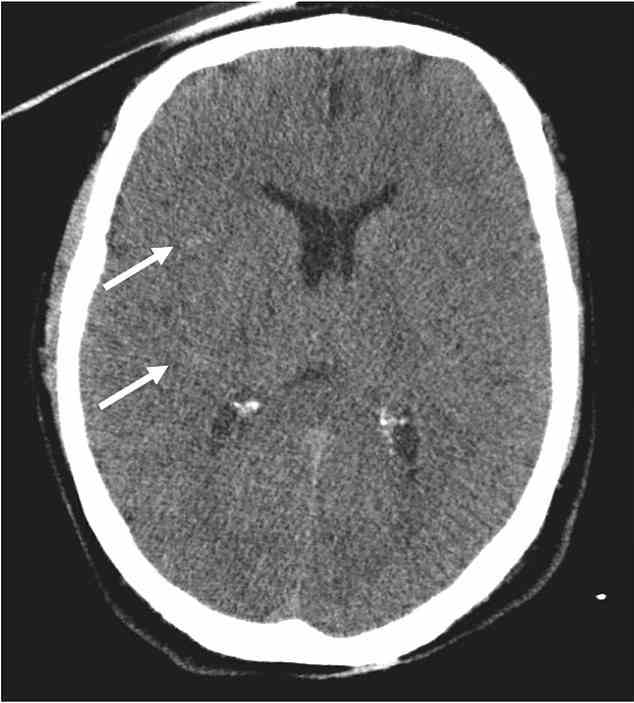 Sein Trommelfell war bei dem Schlag geplatzt und CT-Scans zeigten kleine Blutungen in seinem Gehirn (Bild).