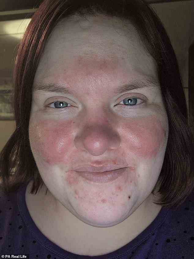 Trotz ihrer Befürchtungen gab Natalie 49,95 £ für ihre Hautpflege aus und war innerhalb von vier Wochen überglücklich mit den Ergebnissen (Bild)