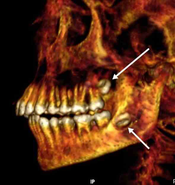Ein CT-Scan der Zähne der Mumie