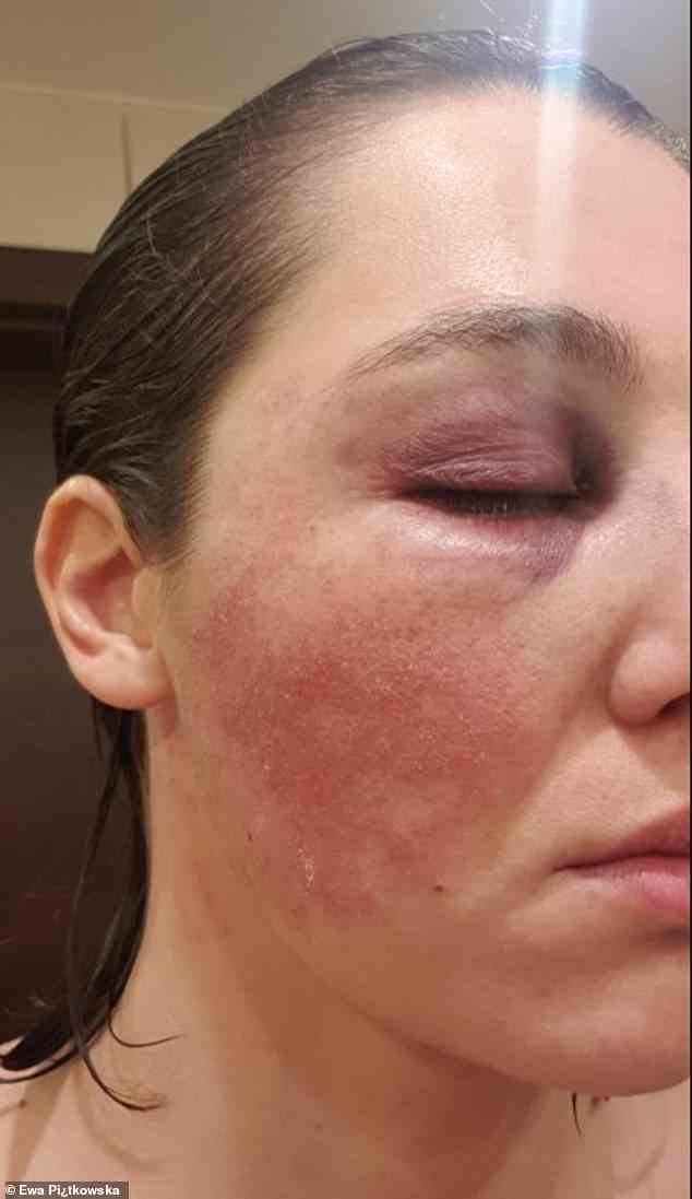 Polish pro boxer and slap fight champion Ewa Pi¿tkowska shared this picture of her injury with MailOnline after her last slap fighting tournament