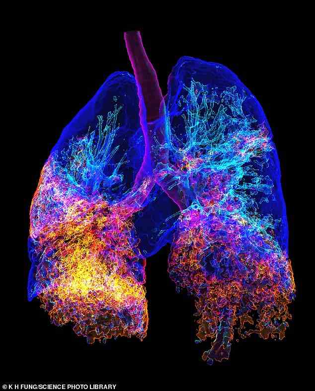 LEBENSBEDROHEND: Ein 3D-Scan der von einer Lungenentzündung betroffenen Lunge