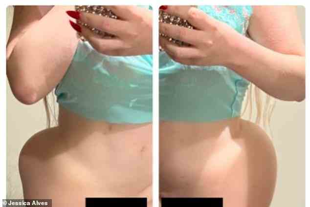 Jessica has had more than 70 surgical procedures to alter her appearance over the years costing over £800,000. In December she  revealed that her bum implants became 'displaced' after she got up too soon while she was still recovering from surgery in Turkey